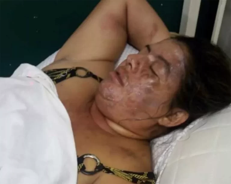 Le arrojó a su concubina una olla con sopa hirviendo en la cara y escapó